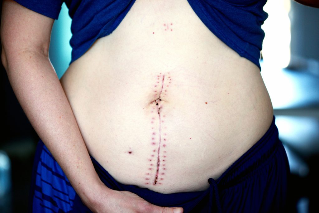 c-section recovery scar