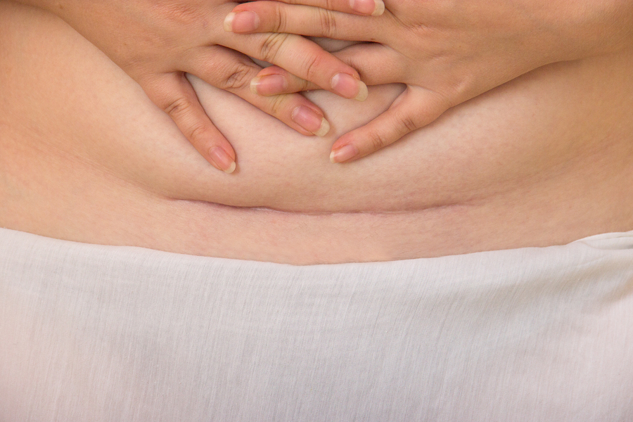 woman holding hands above her c-section scar