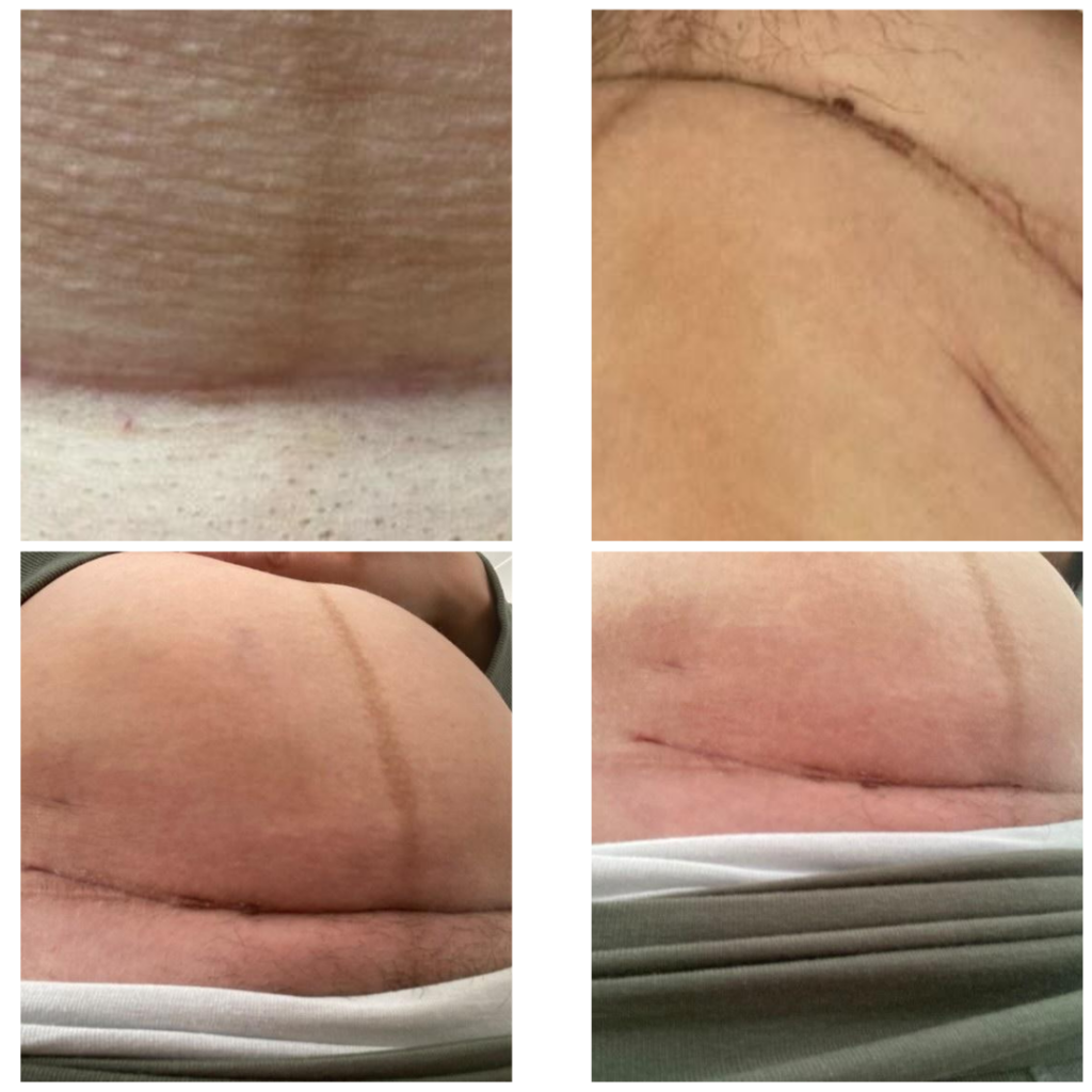 pictrures of different c-section scars