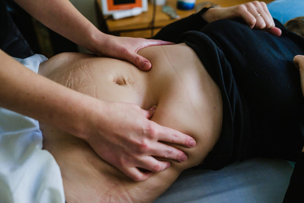 Cupping is a fantastic tool to help reduce cesarean scar adhesions