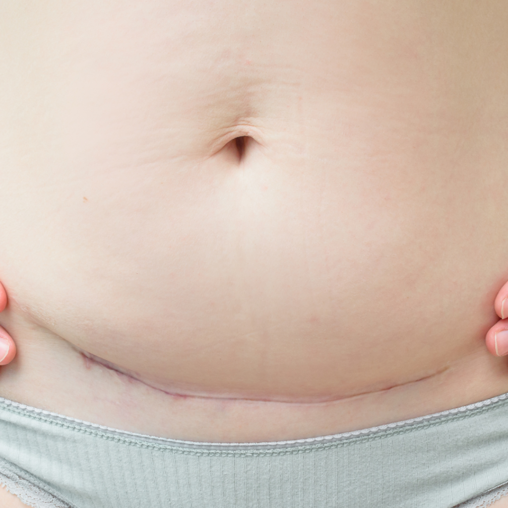 woman's tummy and C-section scar after a C-section birth. how to recover from a c-section.